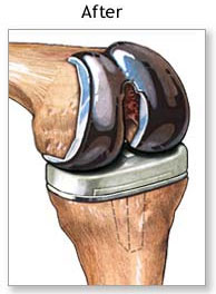 after knee surgery after knee surgery,knee replacement doctors clinic ,knee replacement surgery in delhi,knee replacement surgery in india,knee replacement ,knee replacement