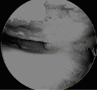 arthroscopic,acl-deficient,acl-deficient knee,damaged articular cartilage,acl injury,acl reconstruction india,acl reconstruction best india,acl reconstructionbest doctors in india,acl reconstruction best surgeon in india,acl reconstructionbest surgery in india,acl reconstruction best treatment in india,acl reconstruction in south india,acl reconstruction north india,acl reconstruction east india,acl reconstruction west india,acl reconstruction best in india,acl reconstruction best surgery in india,acl reconstruction cost-effective in india,acl reconstruction best doctors in india,acl reconstruction india,acl reconstruction india,acl reconstruction india,acl reconstruction now in india,acl reconstruction india