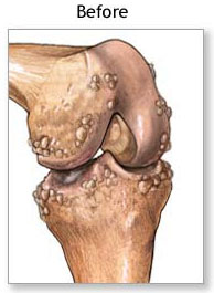 before knee replacement before knee replacement, knee replacementbest surgeon in india, knee replacement best surgery