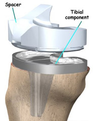 tibial components tibial components,knee replacement india,knee replacement india