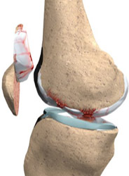 patella cuts patella cuts,knee replacement india
