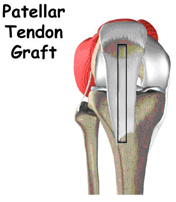 patellar tendon graft,acl injury,acl reconstruction india,acl reconstruction best india,acl reconstructionbest doctors in india,acl reconstruction best surgeon in india,acl reconstructionbest surgery in india,acl reconstruction best treatment in india,acl reconstruction in south india,acl reconstruction north india,acl reconstruction east india,acl reconstruction west india,acl reconstruction best in india,acl reconstruction best surgery in india,acl reconstruction cost-effective in india,acl reconstruction best doctors in india,acl reconstruction india,acl reconstruction india,acl reconstruction india,acl reconstruction now in india,acl reconstruction india
