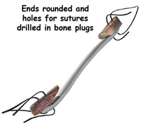 ends rounded and holes for structure drilled in bone plugs,acl injury,acl reconstruction india,acl reconstruction best india,acl reconstructionbest doctors in india,acl reconstruction best surgeon in india,acl reconstructionbest surgery in india,acl reconstruction best treatment in india,acl reconstruction in south india,acl reconstruction north india,acl reconstruction east india,acl reconstruction west india,acl reconstruction best in india,acl reconstruction best surgery in india,acl reconstruction cost-effective in india,acl reconstruction best doctors in india,acl reconstruction india,acl reconstruction india,acl reconstruction india,acl reconstruction now in india,acl reconstruction india