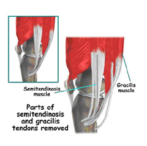 tendons,semitendinosis muscle,acl injury,acl reconstruction india,acl reconstruction best india,acl reconstructionbest doctors in india,acl reconstruction best surgeon in india,acl reconstructionbest surgery in india,acl reconstruction best treatment in  india,acl reconstruction in south  india,acl reconstruction north  india,acl reconstruction  east india,acl reconstruction west india,acl reconstruction best in  india,acl reconstruction best surgery in india,acl reconstruction cost-effective in  india,acl reconstruction best doctors in india,acl reconstruction india,acl reconstruction india,acl reconstruction india,acl reconstruction now in india,acl reconstruction india