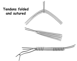 tendons folded and sutured,acl injury,acl reconstruction india,acl reconstruction best india,acl reconstructionbest doctors in india,acl reconstruction best surgeon in india,acl reconstructionbest surgery in india,acl reconstruction best treatment in india,acl reconstruction in south india,acl reconstruction north india,acl reconstruction east india,acl reconstruction west india,acl reconstruction best in india,acl reconstruction best surgery in india,acl reconstruction cost-effective in india,acl reconstruction best doctors in india,acl reconstruction india,acl reconstruction india,acl reconstruction india,acl reconstruction now in india,acl reconstruction india