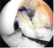 acl injury,acl reconstruction india,acl reconstruction best india,acl reconstructionbest doctors in india,acl reconstruction best surgeon in india,acl reconstructionbest surgery in india,acl reconstruction best treatment in india,acl reconstruction in south india,acl reconstruction north india,acl reconstruction east india,acl reconstruction west india,acl reconstruction best in india,acl reconstruction best surgery in india,acl reconstruction cost-effective in india,acl reconstruction best doctors in india,acl reconstruction india,acl reconstruction india,acl reconstruction india,acl reconstruction now in india,acl reconstruction india