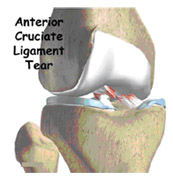 diagnosis,acl injury,acl reconstruction india,acl reconstruction best india,acl reconstructionbest doctors in india,acl reconstruction best surgeon in india,acl reconstructionbest surgery in india,acl reconstruction best treatment in india,acl reconstruction in south india,acl reconstruction north india,acl reconstruction east india,acl reconstruction west india,acl reconstruction best in india,acl reconstruction best surgery in india,acl reconstruction cost-effective in india,acl reconstruction best doctors in india,acl reconstruction india,acl reconstruction india,acl reconstruction india,acl reconstruction now in india,acl reconstruction india