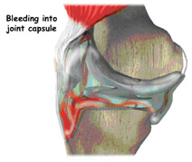 bleeding into joint capsule,acl injury,acl reconstruction india,acl reconstruction best india,acl reconstructionbest doctors in india,acl reconstruction best surgeon in india,acl reconstructionbest surgery in india,acl reconstruction best treatment in  india,acl reconstruction in south  india,acl reconstruction north  india,acl reconstruction  east india,acl reconstruction west india,acl reconstruction best in  india,acl reconstruction best surgery in india,acl reconstruction cost-effective in  india,acl reconstruction best doctors in india,acl reconstruction india,acl reconstruction india,acl reconstruction india,acl reconstruction now in india,acl reconstruction india