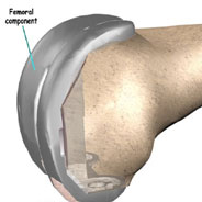 femoral component femoral component,knee replacement india,knee replacement delhi,knee replacment india