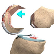 femur cut femur cut,knee replacement now in india