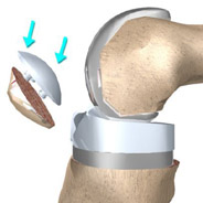 patella implants patella implants,knee replacement india,knee replacement india