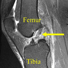 femur,acl injury,acl reconstruction india,acl reconstruction best india,acl reconstructionbest doctors in india,acl reconstruction best surgeon in india,acl reconstructionbest surgery in india,acl reconstruction best treatment in  india,acl reconstruction in south  india,acl reconstruction north  india,acl reconstruction  east india,acl reconstruction west india,acl reconstruction best in  india,acl reconstruction best surgery in india,acl reconstruction cost-effective in  india,acl reconstruction best doctors in india,acl reconstruction india,acl reconstruction india,acl reconstruction india,acl reconstruction now in india,acl reconstruction india