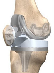 final picture of knee replacement final picture of knee replacement,knee replacement india