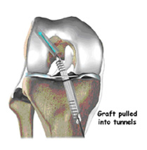 surgical procedure,acl injury,acl reconstruction india,acl reconstruction best india,acl reconstructionbest doctors in india,acl reconstruction best surgeon in india,acl reconstructionbest surgery in india,acl reconstruction best treatment in india,acl reconstruction in south india,acl reconstruction north india,acl reconstruction east india,acl reconstruction west india,acl reconstruction best in india,acl reconstruction best surgery in india,acl reconstruction cost-effective in india,acl reconstruction best doctors in india,acl reconstruction india,acl reconstruction india,acl reconstruction india,acl reconstruction now in india,acl reconstruction india