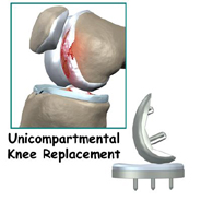unicompartmental knee replacement unicompartmental knee replacement,knee replacement india