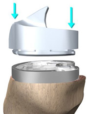 tibia components tibia components,knee replacement india