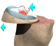 tibia cut tibia cut,knee replacement india,knee replacement delhi,knee replace india ,knee replacement in delhi,india