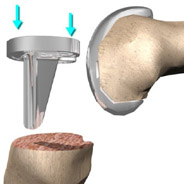 tibia tray tibia tray,knee replacement india