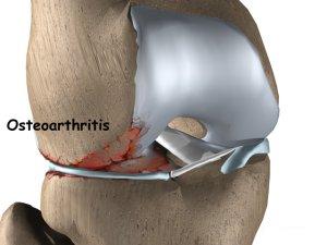 knee replacement india