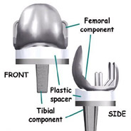 components components,knee replacement, knee replacement surgeon, knee replacement surgeon in india,knee replacement india