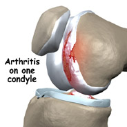 unicompartment damage unicompartment damage,knee replacement india,india