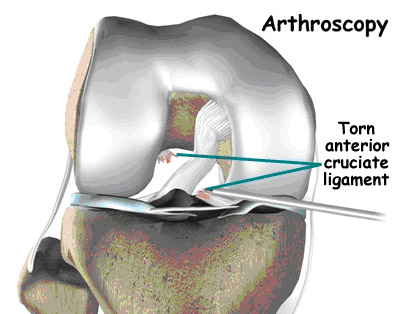 acl tear,acl torn,acl injury,acl reconstruction india,acl reconstruction best india,acl reconstructionbest doctors in india,acl reconstruction best surgeon in india,acl reconstructionbest surgery in india,acl reconstruction best treatment in india,acl reconstruction in south india,acl reconstruction north india,acl reconstruction east india,acl reconstruction west india,acl reconstruction best in india,acl reconstruction best surgery in india,acl reconstruction cost-effective in india,acl reconstruction best doctors in india,acl reconstruction india,acl reconstruction india,acl reconstruction india,acl reconstruction now in india,acl reconstruction india