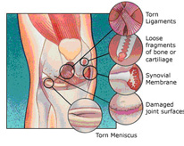 arthroscopy in india ,arthroscopy in chhattisgarh,arthroscopy india
