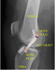 femur,surgical procedure,acl injury,acl reconstruction india,acl reconstruction best india,acl reconstructionbest doctors in india,acl reconstruction best surgeon in india,acl reconstructionbest surgery in india,acl reconstruction best treatment in india,acl reconstruction in south india,acl reconstruction north india,acl reconstruction east india,acl reconstruction west india,acl reconstruction best in india,acl reconstruction best surgery in india,acl reconstruction cost-effective in india,acl reconstruction best doctors in india,acl reconstruction india,acl reconstruction india,acl reconstruction india,acl reconstruction now in india,acl reconstruction india