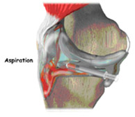 aspiration,acl injury,acl reconstruction india,acl reconstruction best india,acl reconstructionbest doctors in india,acl reconstruction best surgeon in india,acl reconstructionbest surgery in india,acl reconstruction best treatment in india,acl reconstruction in south india,acl reconstruction north india,acl reconstruction east india,acl reconstruction west india,acl reconstruction best in india,acl reconstruction best surgery in india,acl reconstruction cost-effective in india,acl reconstruction best doctors in india,acl reconstruction india,acl reconstruction india,acl reconstruction india,acl reconstruction now in india,acl reconstruction india