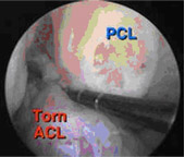 torn acl,acl injury,acl reconstruction india,acl reconstruction best india,acl reconstructionbest doctors in india,acl reconstruction best surgeon in india,acl reconstructionbest surgery in india,acl reconstruction best treatment in india,acl reconstruction in south india,acl reconstruction north india,acl reconstruction east india,acl reconstruction west india,acl reconstruction best in india,acl reconstruction best surgery in india,acl reconstruction cost-effective in india,acl reconstruction best doctors in india,acl reconstruction india,acl reconstruction india,acl reconstruction india,acl reconstruction now in india,acl reconstruction india