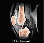 artist enhanced,acl injury,acl reconstruction india,acl reconstruction best india,acl reconstructionbest doctors in india,acl reconstruction best surgeon in india,acl reconstructionbest surgery in india,acl reconstruction best treatment in india,acl reconstruction in south india,acl reconstruction north india,acl reconstruction east india,acl reconstruction west india,acl reconstruction best in india,acl reconstruction best surgery in india,acl reconstruction cost-effective in india,acl reconstruction best doctors in india,acl reconstruction india,acl reconstruction india,acl reconstruction india,acl reconstruction now in india,acl reconstruction india